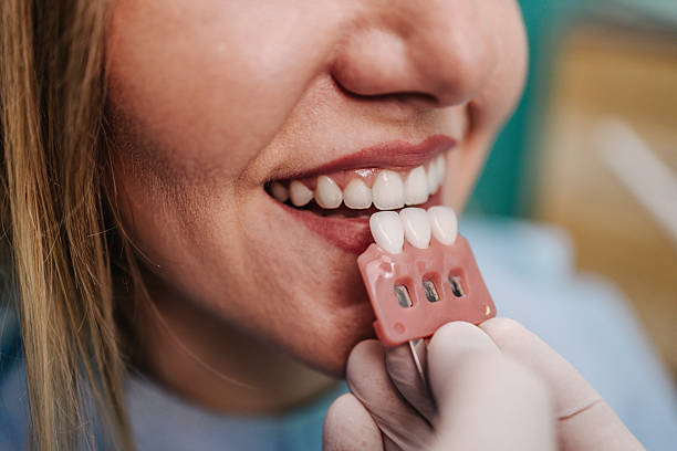 Veneers treatment at Moonstone Dental Centre in Oakville
