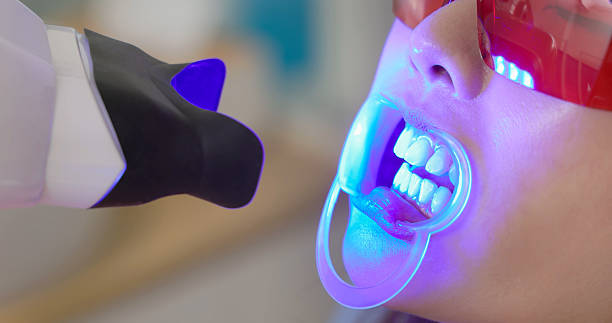 Teeth Whitening treatment at Moonstone Dental Centre in Oakville
