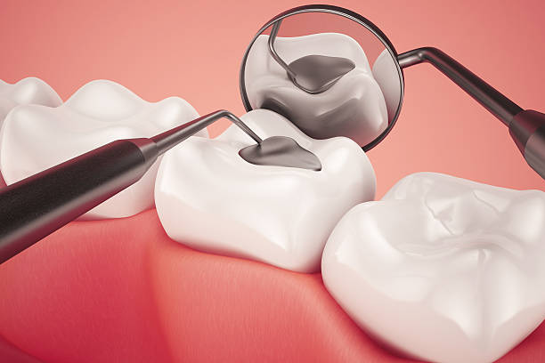 Composite Fillings treatment at Moonstone Dental Centre in Oakville